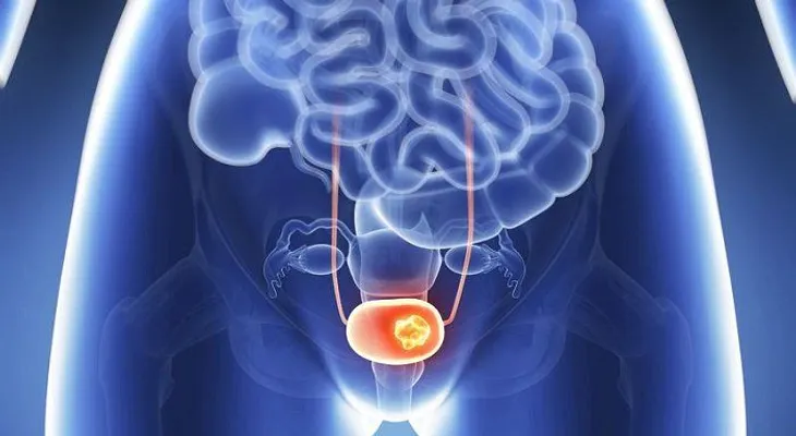 10 síntomas de cáncer de vejiga que cada mujer necesita saber
