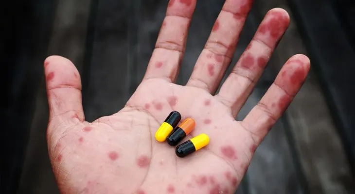 Vuelve la fiebre escarlata
