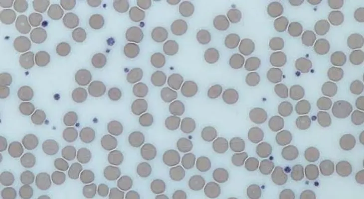 El exceso de plaquetas en sangre podría alertar de la presencia de un cáncer
