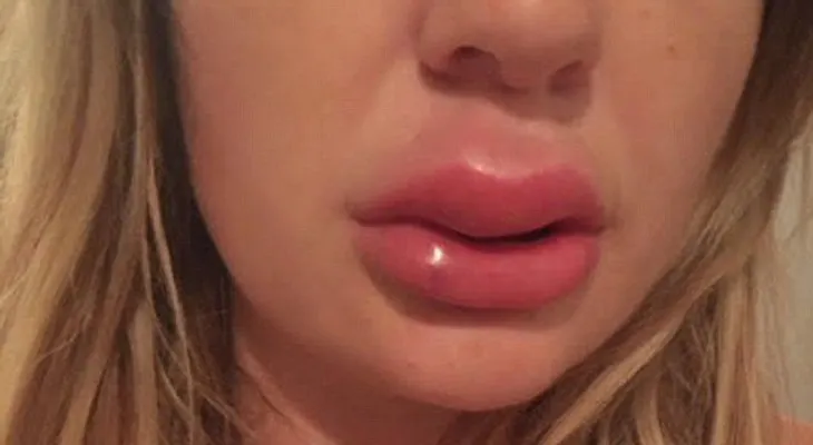 Jessica Bennett, compartió un video mostrando pus de sus labios infectados por un relleno â??baratoâ??