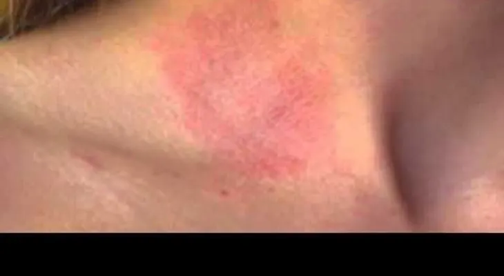 Alergias (VIDEO)