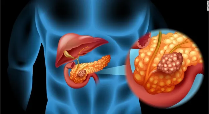 La diabetes después de los 50 podría ser un signo temprano de cáncer de páncreas