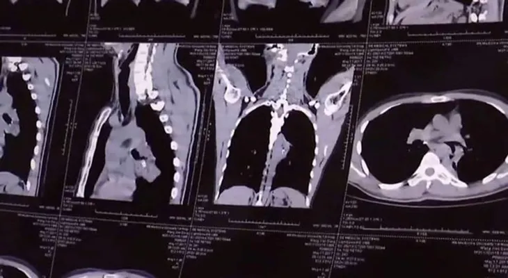 Tenía 20 años con ataques de tos, lo operaron y descubrieron un insólito objeto en sus pulmones