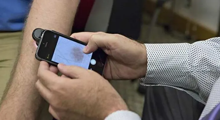 Aplicaciones móviles permitirán futura detección temprana del cáncer de piel