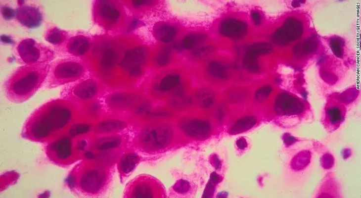 Desarrollan un implante que captura las células malignas del cáncer