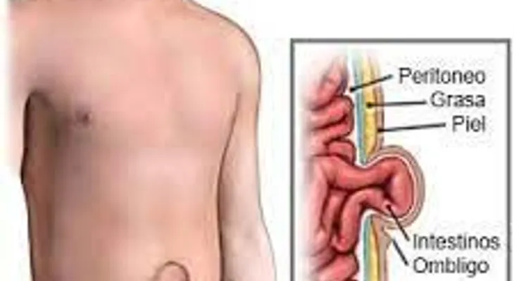 Tratamiento natural para la hernia umbilical