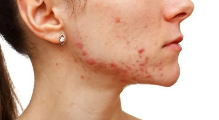 10 síntomas de desequilibrio hormonal que debes atender 