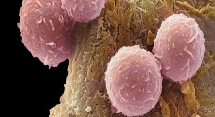 Descubren por qué fallan ltratamientos contra el cáncer