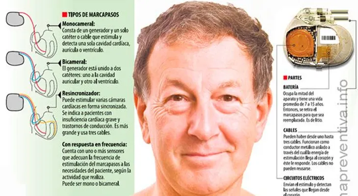 El marcapasos va rumbo a su fin
