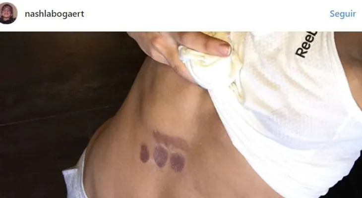 Nashla se quema la barriga con una plancha