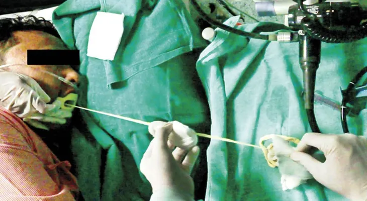 Médicos retiran una lombriz de casi dos metros del estómago de un hombre