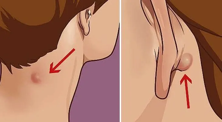 ¿Si tienes una protuberancia en el cuello, la espalda o detrás de la oreja?: Aquí está lo que necesita saber... 