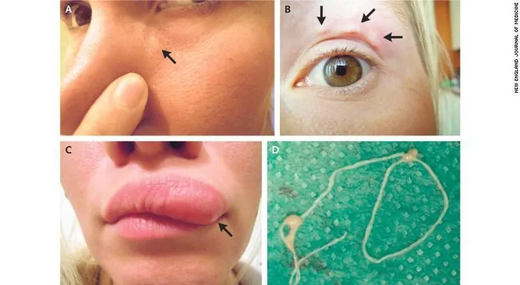 Estas selfies muestran el bulto que se movía en la cara de una mujer: era un gusano