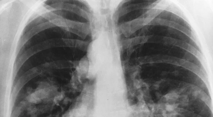 Estudio: Los niños nacidos en invierno tienen un defecto común