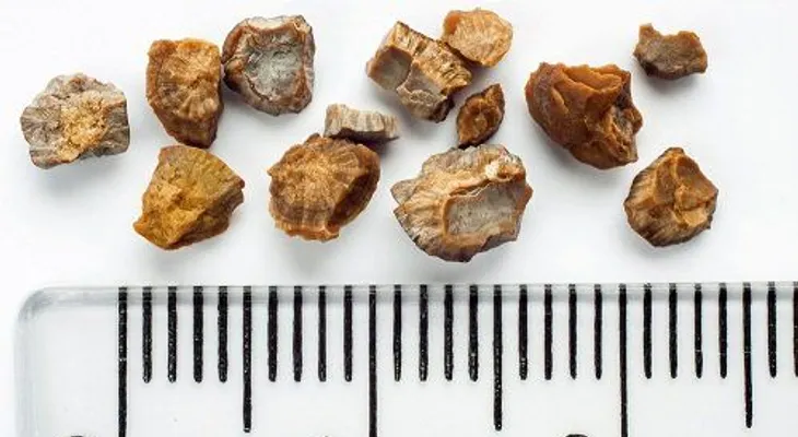 Trata las piedras en los riñones con vinagre de manzana