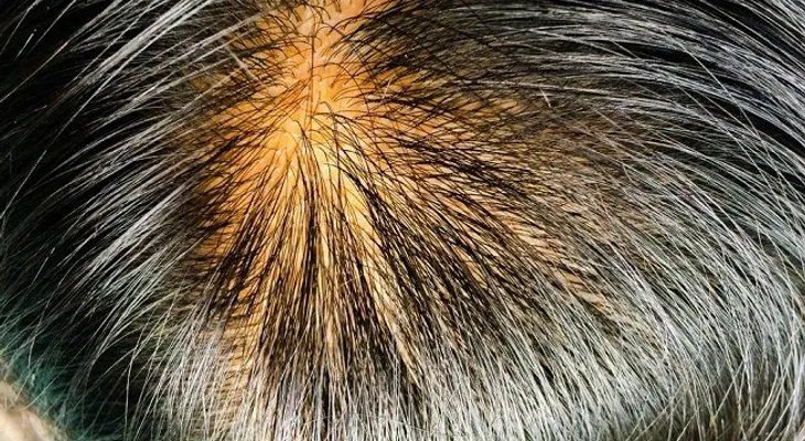 Remedio para combatir el exceso de sebo en el pelo y evitar su caída