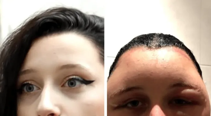 Tinte de pelo le infló la cabeza y casi la mata