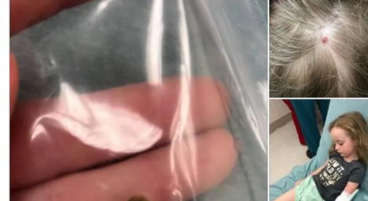 Niña sufre parálisis luego de recibir una picadura de garrapata en la cabeza