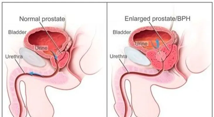 Testimonio: curar cáncer de próstada de forma natural 