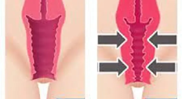 Un remedio imperdible para estrechar la vagina; mejor que una cirugía