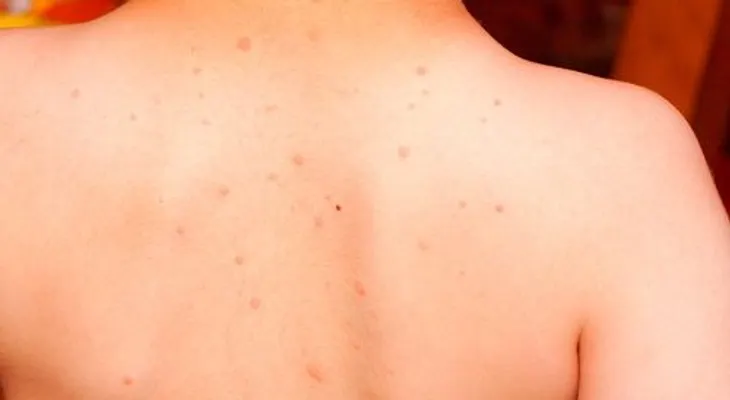 La varicela en los niños sus causas y tratamiento natural