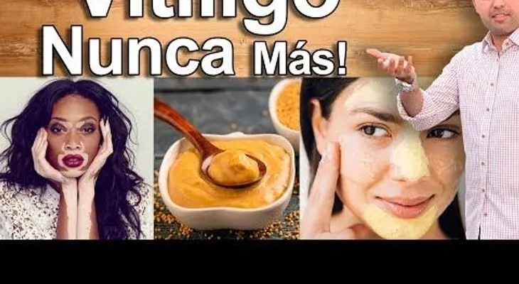Remedios caseros para el vitiligo