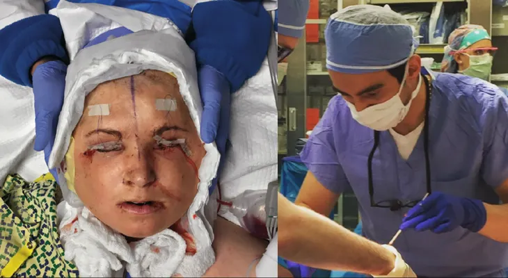 El cirujano que participó en trasplante de rostro a la paciente más joven del mundo, revela detalles de la operación