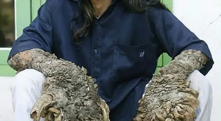 El hombre árbol ¿mito o enfermedad?