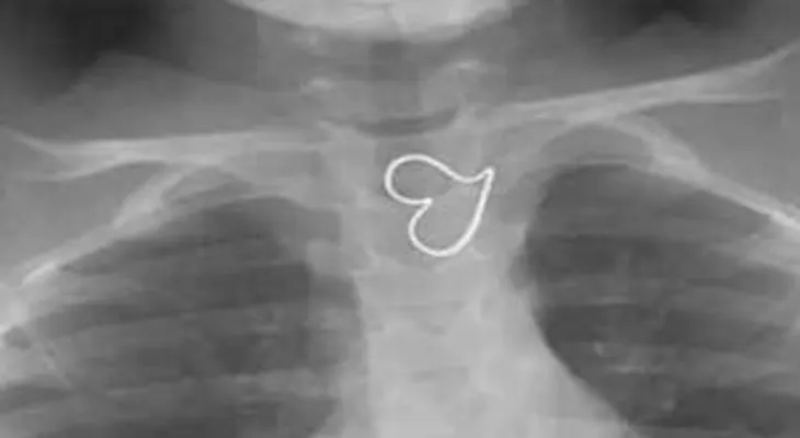 Caso de niña con dos corazones en el pecho causa asombro de doctores 