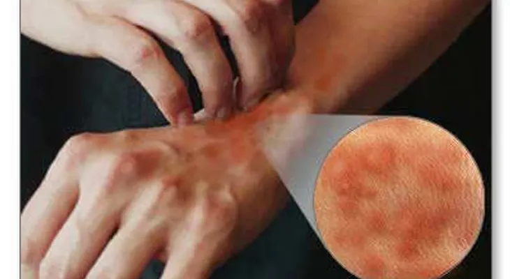 Síntomas de la alergia al látex