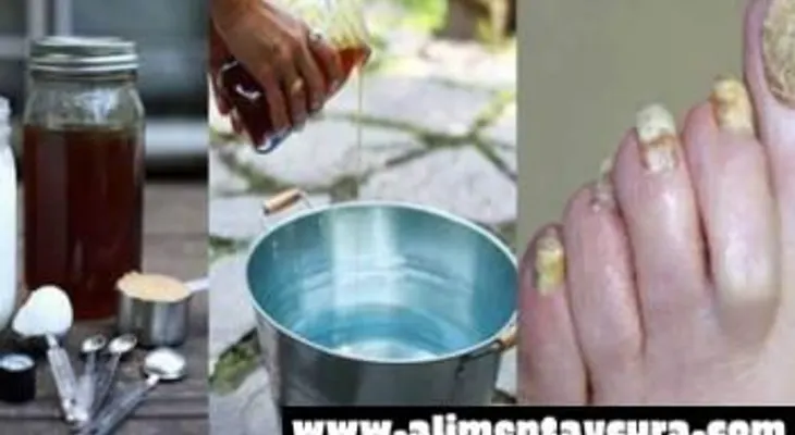 Elimina los hongos de tu cuerpo con este poderoso tónico casero