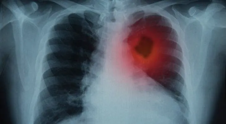  Los pulmones son la vida del sistema respiratorio: ¿Cómo se produce el cáncer?