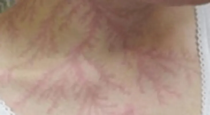 El misterio de la fibromialgia se resuelve al fin! 