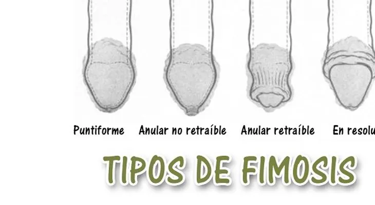 La fimosis, una enfermedad común en el pene del hombre; cómo detectarla