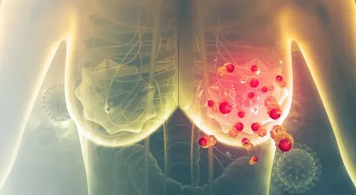 La inmunoterapia logra reducir recurrencia del cáncer de mama más agresivo 