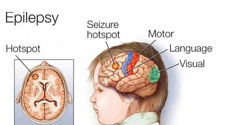 ¿La epilepsia no dura toda la vida en algunas personas?