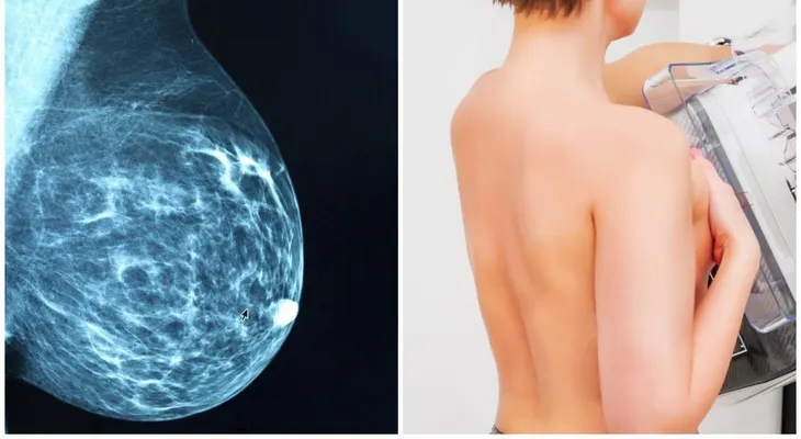 Estudian 629.000 mamografías para ver qué tumores se pueden malignizar