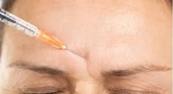 Botox: ¿Qué es, cómo funciona y cuáles son sus mitos y verdades?