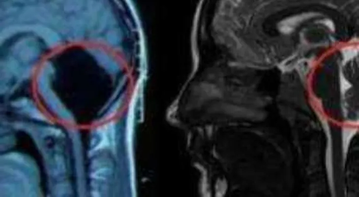 La joven china que probó que se puede vivir sin cerebelo.