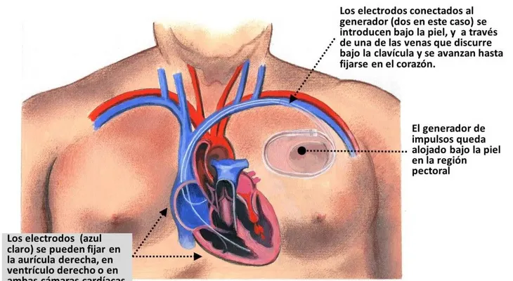 Cecanot realizará jornada gratuita de implantes de marcapasos y cateterismos