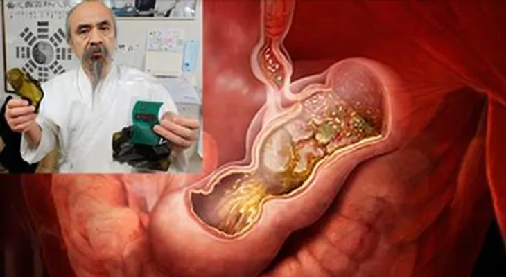 Un brócoli, sal marina y 250 ml de agua; remedio para eliminar el Helicobacter Pylori revelado por médico japonés