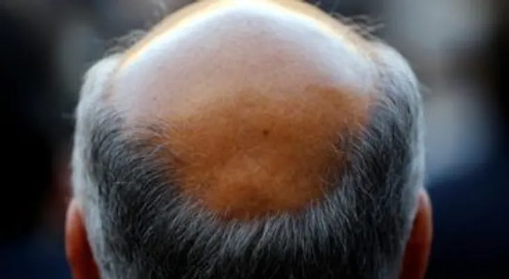 Científicos descubren medicamento combate las canas y pérdida de cabello, y dietas altas en grasa y colesterol