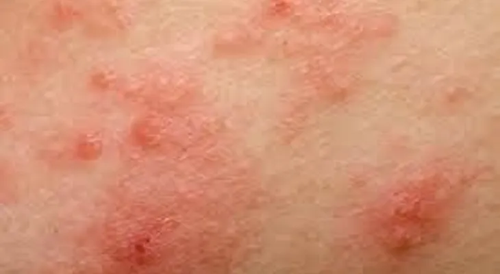 Especialista advierte sobre aumento de dermatitis atópica