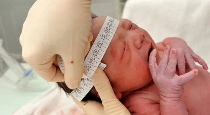 Nace primer bebé en NY con microcefalia asociado al Zika 