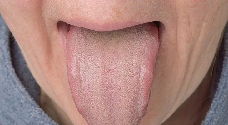 Lengua blanca, cuáles son sus causas y los mejores remedios para tratarla