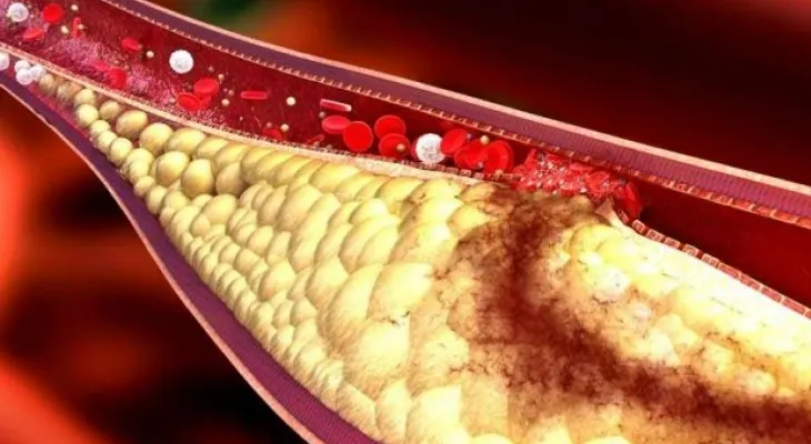 EEUU analiza sangre que evalúa riesgo ataque cardíaco mediante ceramidas en el plasma