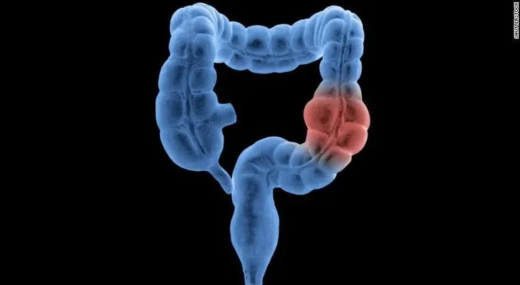 Las pruebas del cáncer de colón deberían empezar a los 45 años, dice nueva pauta