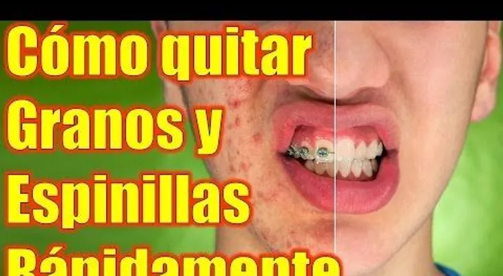 Anota los mejores mejores Remedios Caseros para quitar el Acné (Granos y Espinillas)