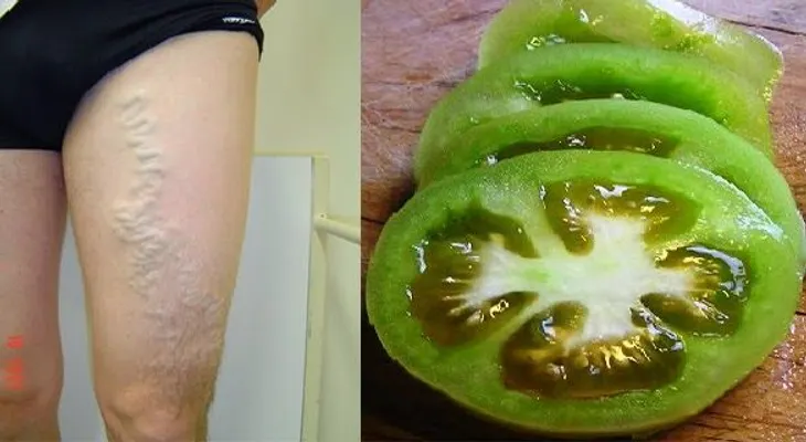 Tomates verdes y rojos para curar las venas varicosas 