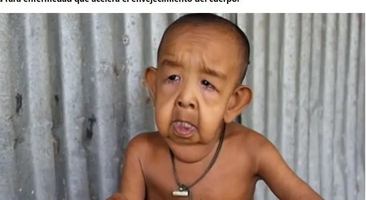 Benjamin Button: La tragedia de un niño de 4 años que tiene aspecto de anciano